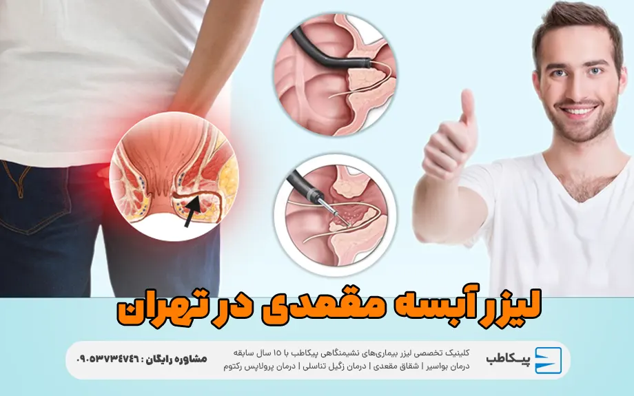 لیزر آبسه مقعدی در تهران