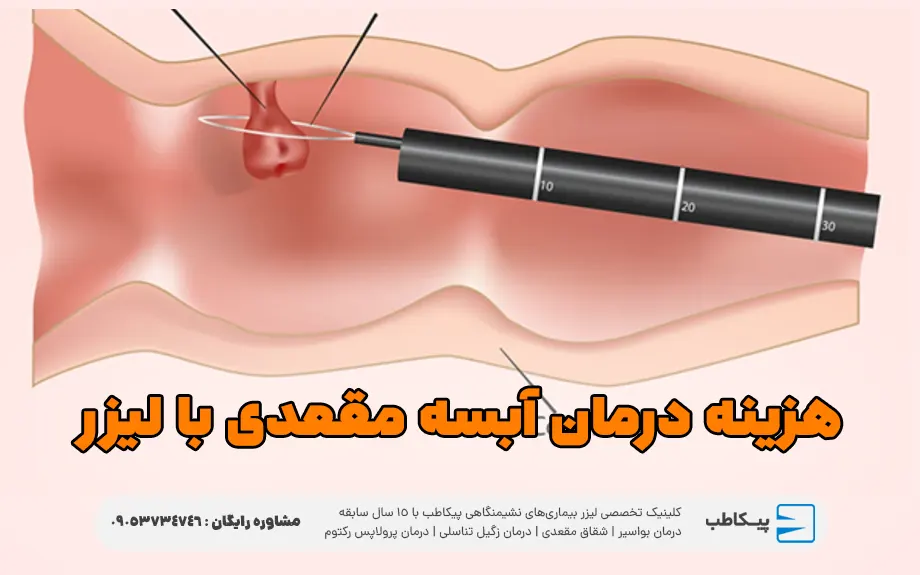 هزینه درمان آبسه مقعدی با لیزر