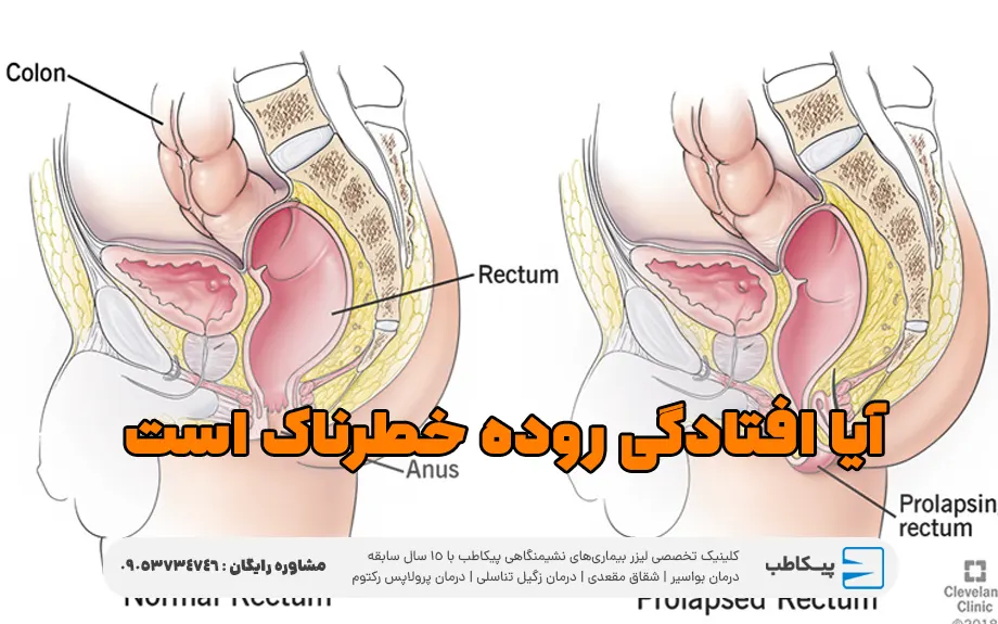 آیا افتادگی روده خطرناک است؟