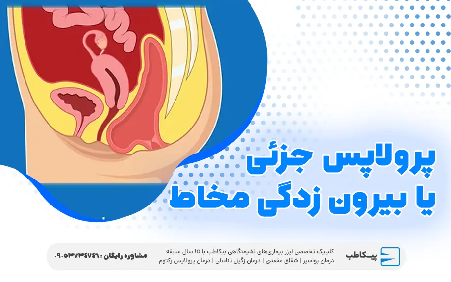 پرولاپس جزئی یا بیرون زدگی مخاط