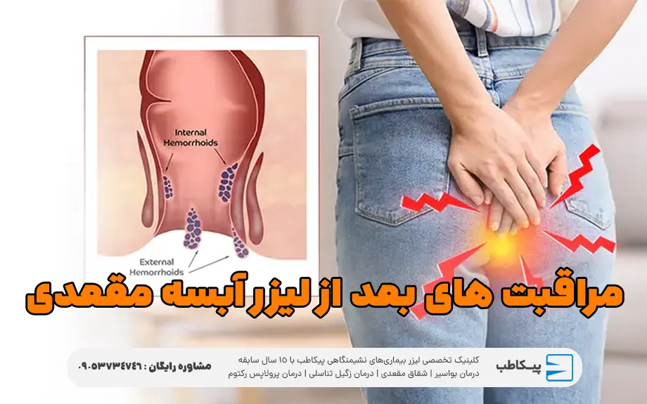 مراقبت های بعد از لیزر آبسه مقعدی