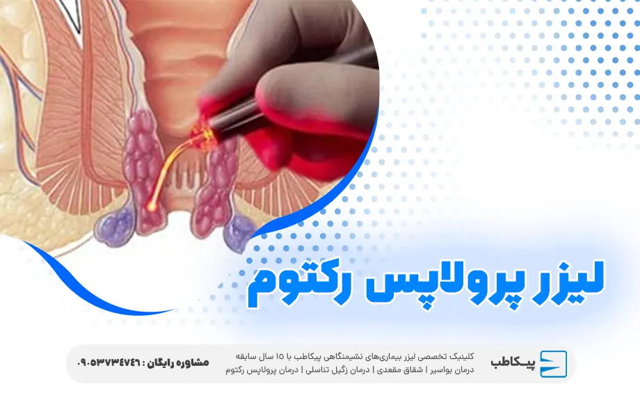 پرولاپس رکتوم با لیزر
