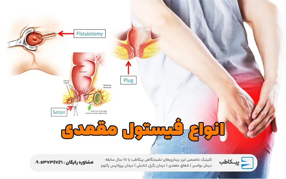 انواع فیستول مقعدی