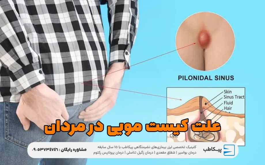 علت کیست مویی در مردان