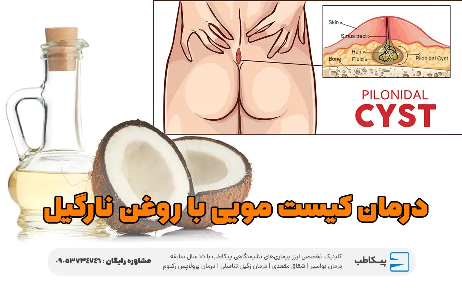 روغن نارگیل و تخلیه کیست مویی در خانه