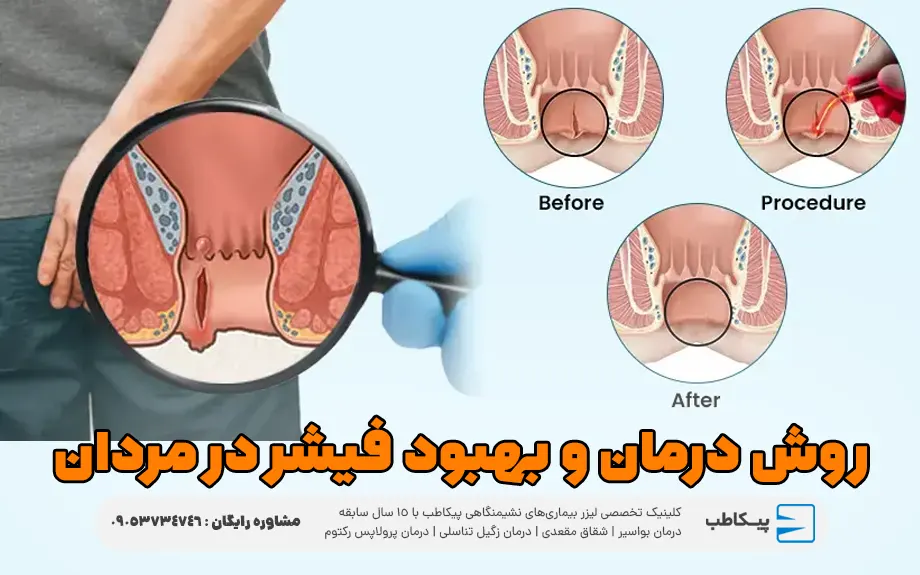 روش درمان و بهبود فیشر در مردان