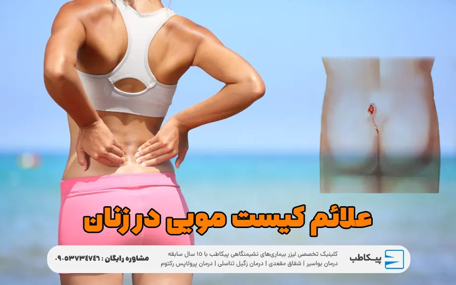 علائم کیست مویی در زنان