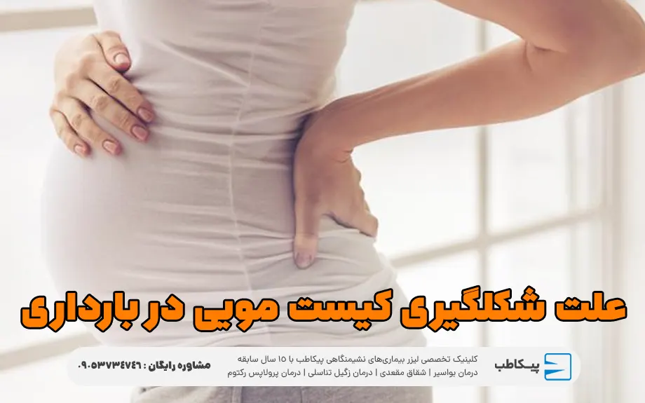 علت شکلگیری کیست مویی در بارداری