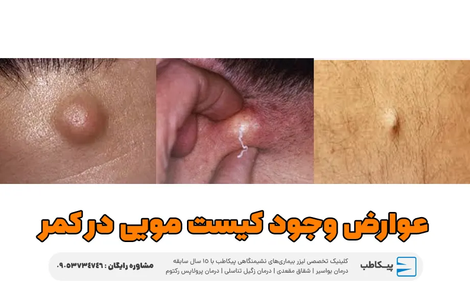 عوارض وجود کیست مویی در کمر