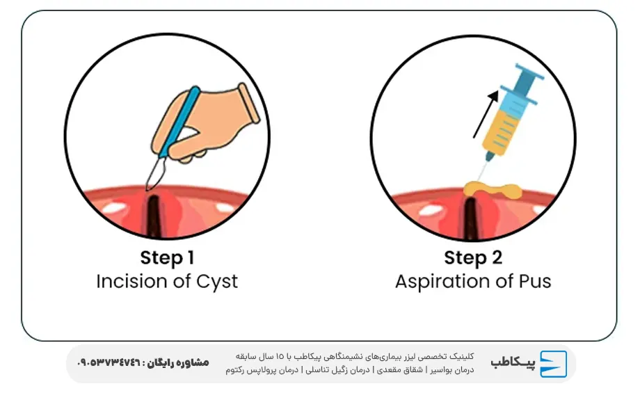 چسب فیبرین برای کیست مویی