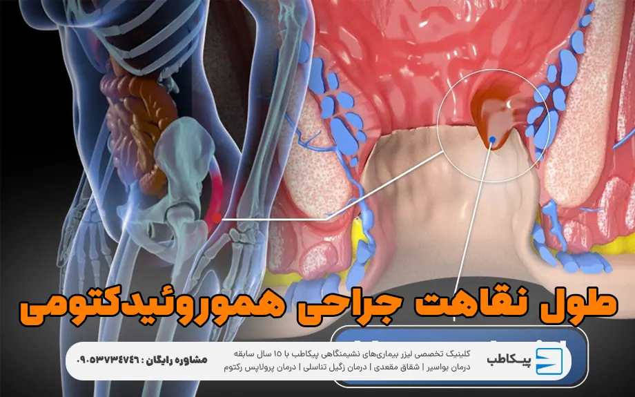 طول نقاهت جراحی هموروئیدکتومی