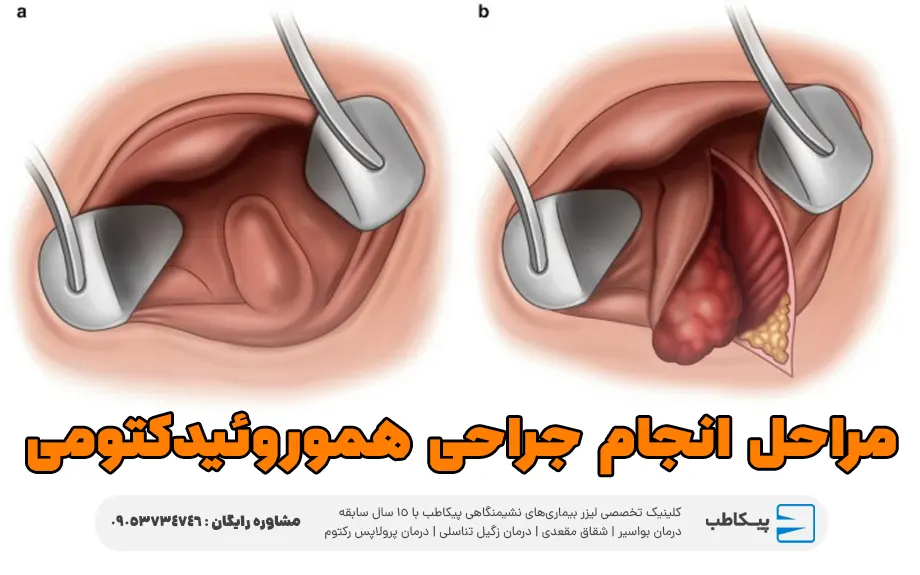 مراحل انجام جراحی هموروئیدکتومی بواسیر