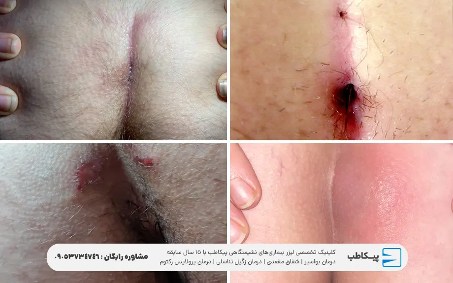 عکس عفونت کیست مویی پس از عمل