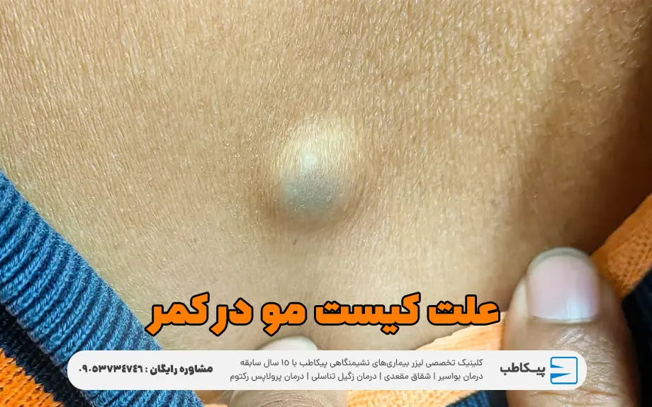 علت کیست مو در کمر