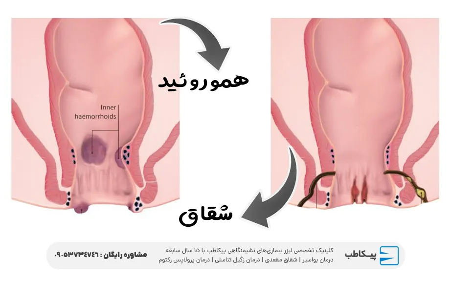 فرق شقاق و بواسیر در میزان درد
