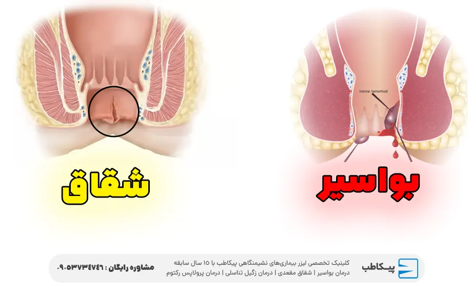 فرق بواسیر و شقاق در ظاهر