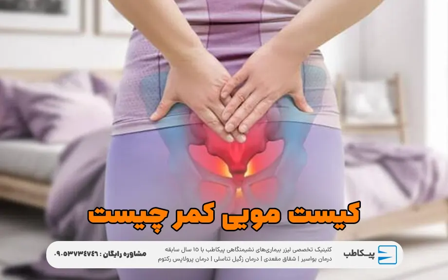 کیست مویی کمر چیست؟