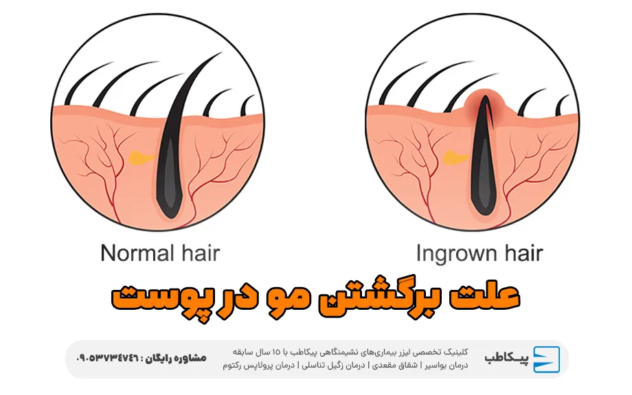علت برگشتن مو در پوست