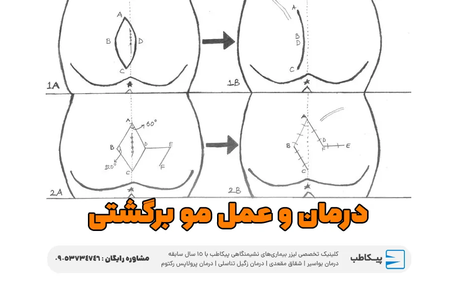 درمان و عمل مو برگشتی