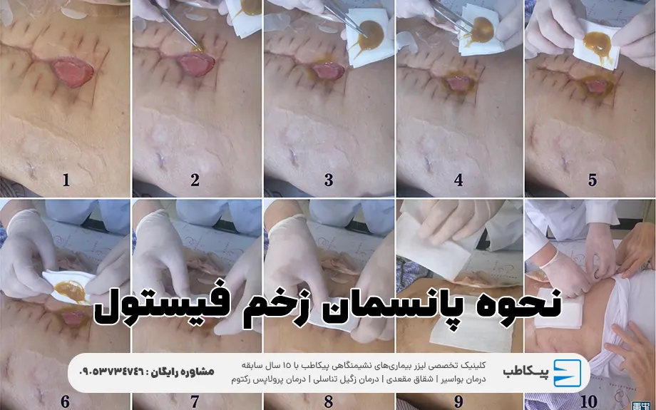 نحوه پانسمان زخم فیستول