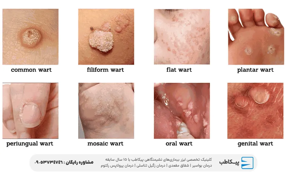 خطر زگیل تناسلی