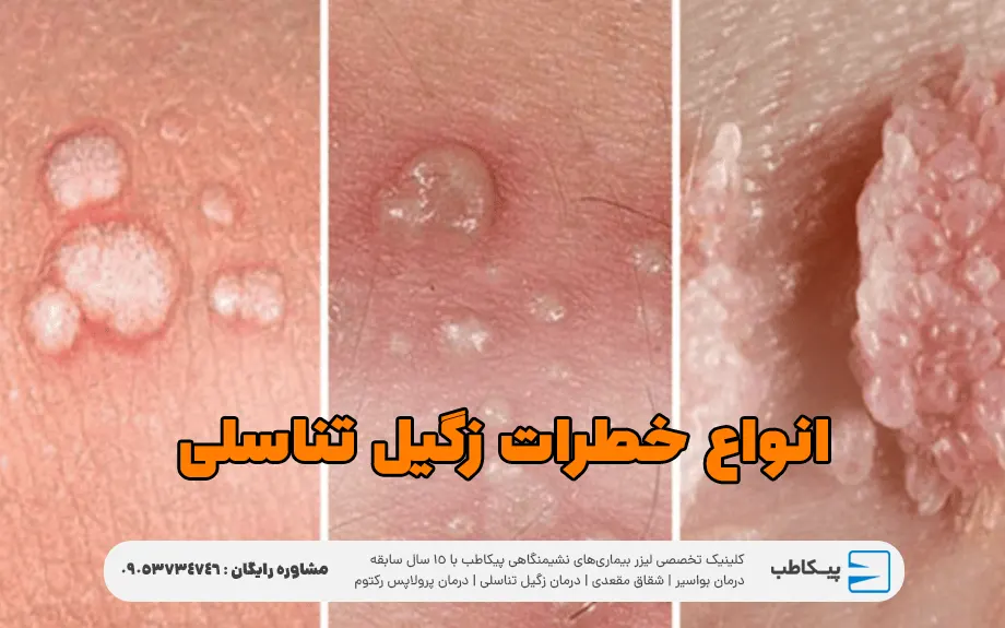 انواع خطرات زگیل تناسلی