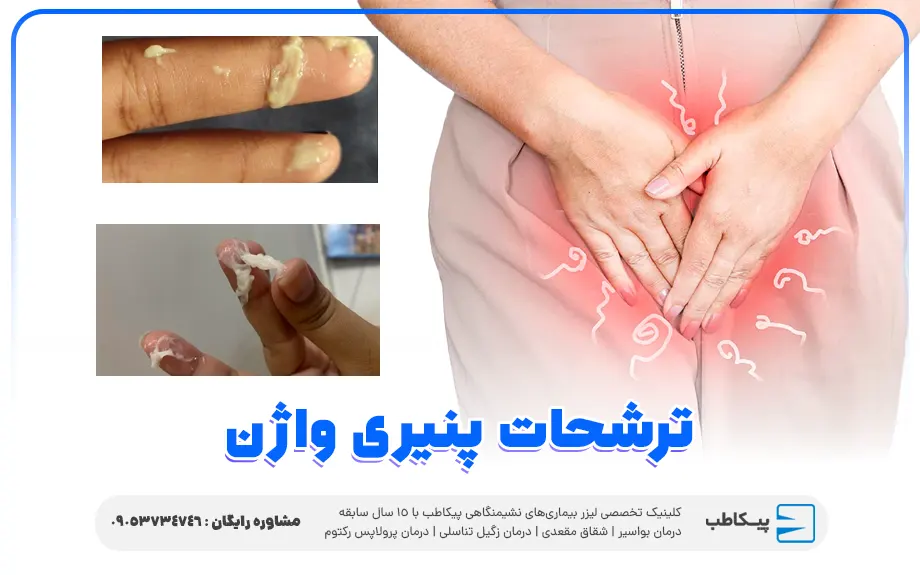 ترشحات پنیری واژن