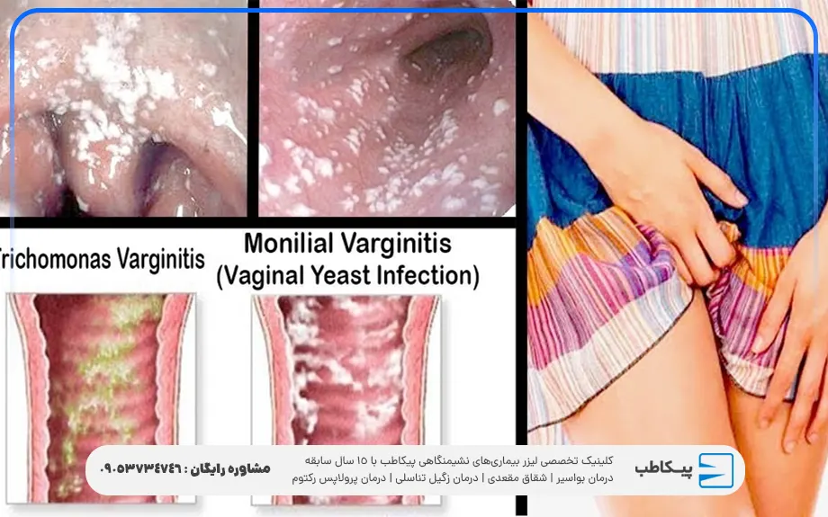 درمان عفونت واژن در خانه با نمک
