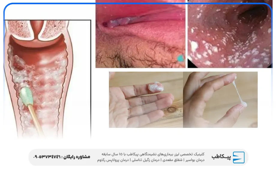 عکس انواع عفونت واژن