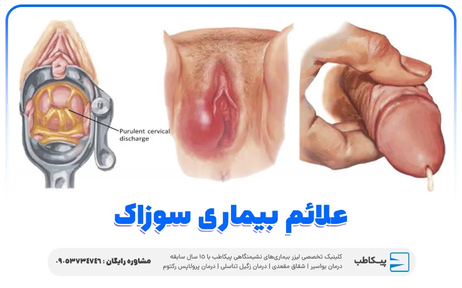 علائم بیماری سوزاک