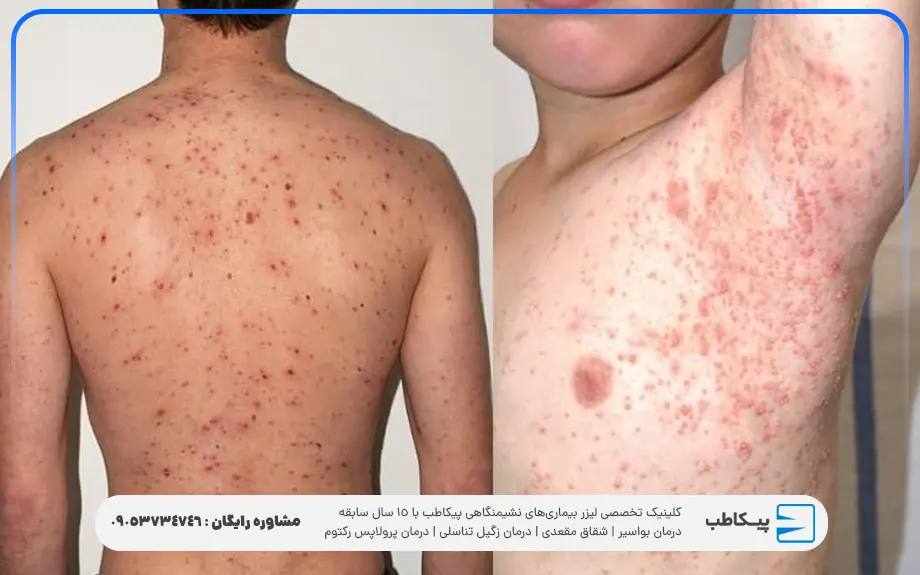 عکس زگیل آبکی 