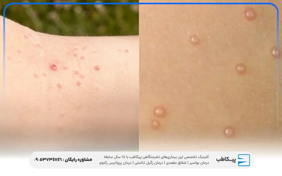 علائم مولوسکوم تناسلی