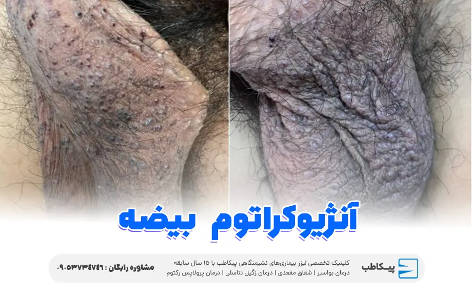 آنژیوکراتوم بیضه