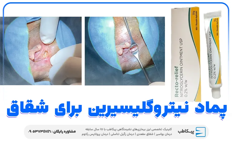 پماد نیتروگلیسیرین برای شقاق