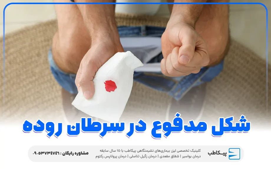 شکل مدفوع در سرطان روده